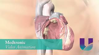 UHNN - Lead-Less Pacemaker