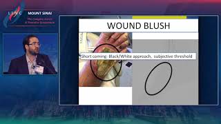 Assessing Foot Perfusion After BTK Revascularization