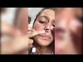 Popping huge blackheads and giant pimples  best pimple poppings 128