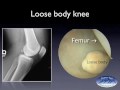 Surgical Video of a Loose Body Removal from a Knee