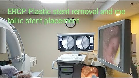 Cholangiocarcinoma ERCP plastic stent removal and metallic stent placement #BD_ENDOSCOPY
