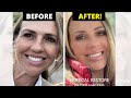 Amazing facelift before and after she looks 15 years younger
