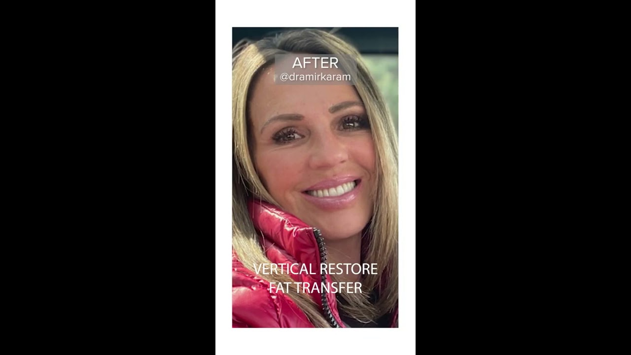AMAZING Facelift Before And After She Looks 15 Years Younger 