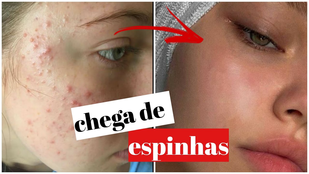 COMO ACABAR COM AS ESPINHAS!!😆 Dicas para acabar com as espinhas de vez ...