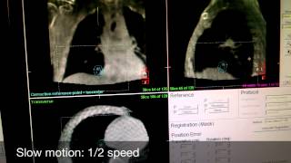 UCSF Innovations: 4D ConeBeam CT