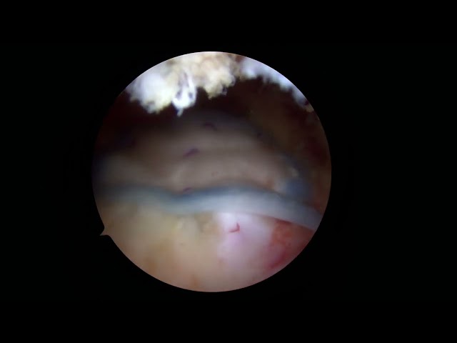 Malla bioinductiva Regeneten