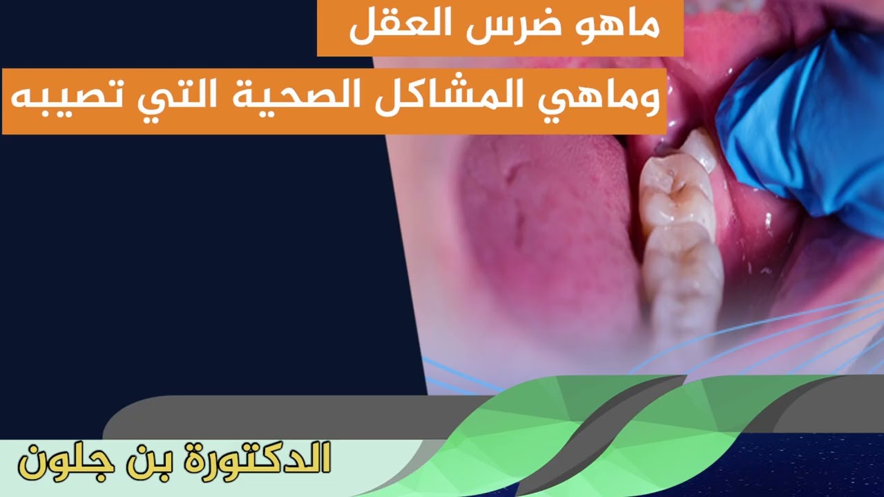 ماهو ضرس العقل وماهي المشاكل الصحية التي تصيبه الدكتورة بن جلون