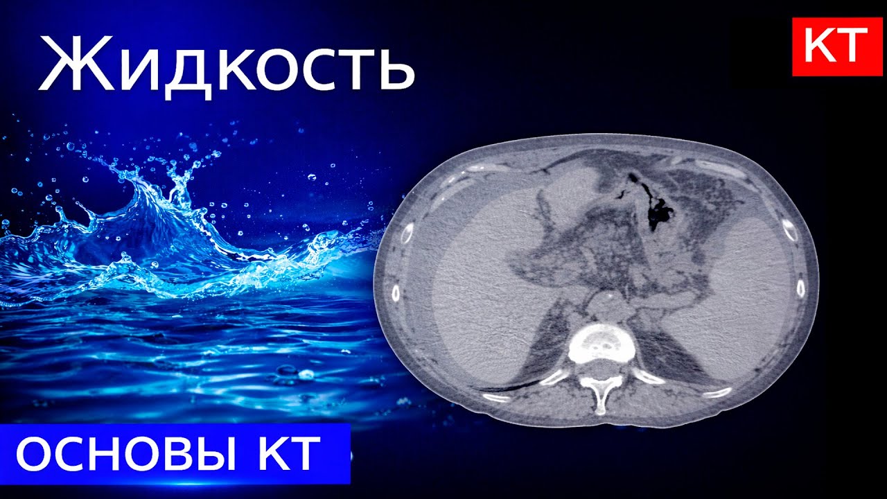 Лучевая диагностика | Жидкость на КТ : асцит, плеврит, кисты, ранулы ...