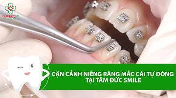 CẬN CẢNH NIỀNG RĂNG MẮC CÀI TỰ ĐÓNG [Tâm Đức Smile]