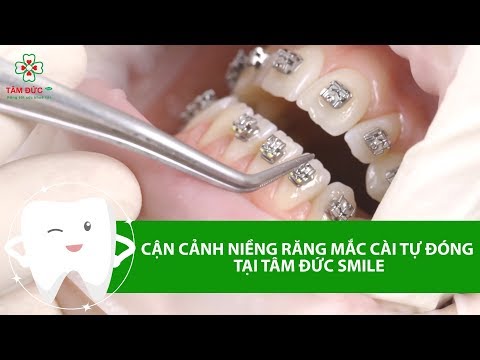 Video CẬN CẢNH NIỀNG RĂNG MẮC CÀI TỰ ĐÓNG [Tâm Đức Smile] - youtube