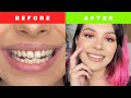 INVISALIGN TREATMENT BEFORE &amp; AFTER MY JOURNEY!