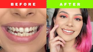 INVISALIGN TREATMENT BEFORE &amp; AFTER MY JOURNEY!