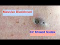 Massive 3 year old blackhead finally comes out dr khaled sadek lipomacystcom