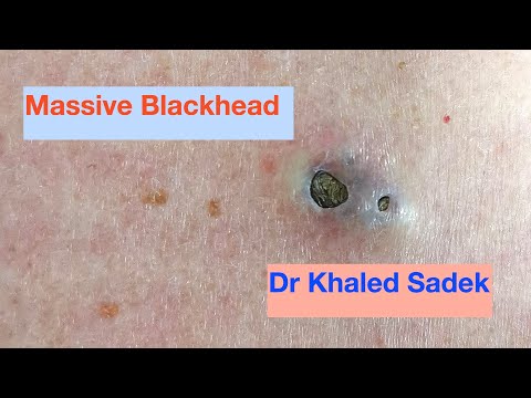 Massive 3 year old Blackhead finally comes out. Dr Khaled Sadek. LipomaCyst.com