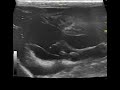 Renal form of FIP: ultrasound (2)