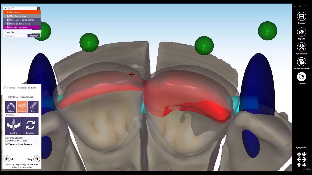 Diseño de carillas en centrales con exoCAD