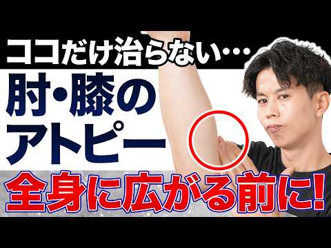 [Common knowledge for atopic dermatitis?] Why Eczema and Itching Flare Up Behind the Elbows and K...