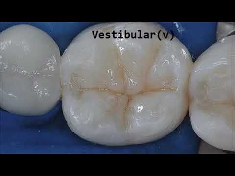 Video: Anatomia Del Dente: Diagramma, Struttura E Funzione, Condizioni Correlate