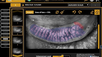 Topcon MYAH; Analyse traanfilm