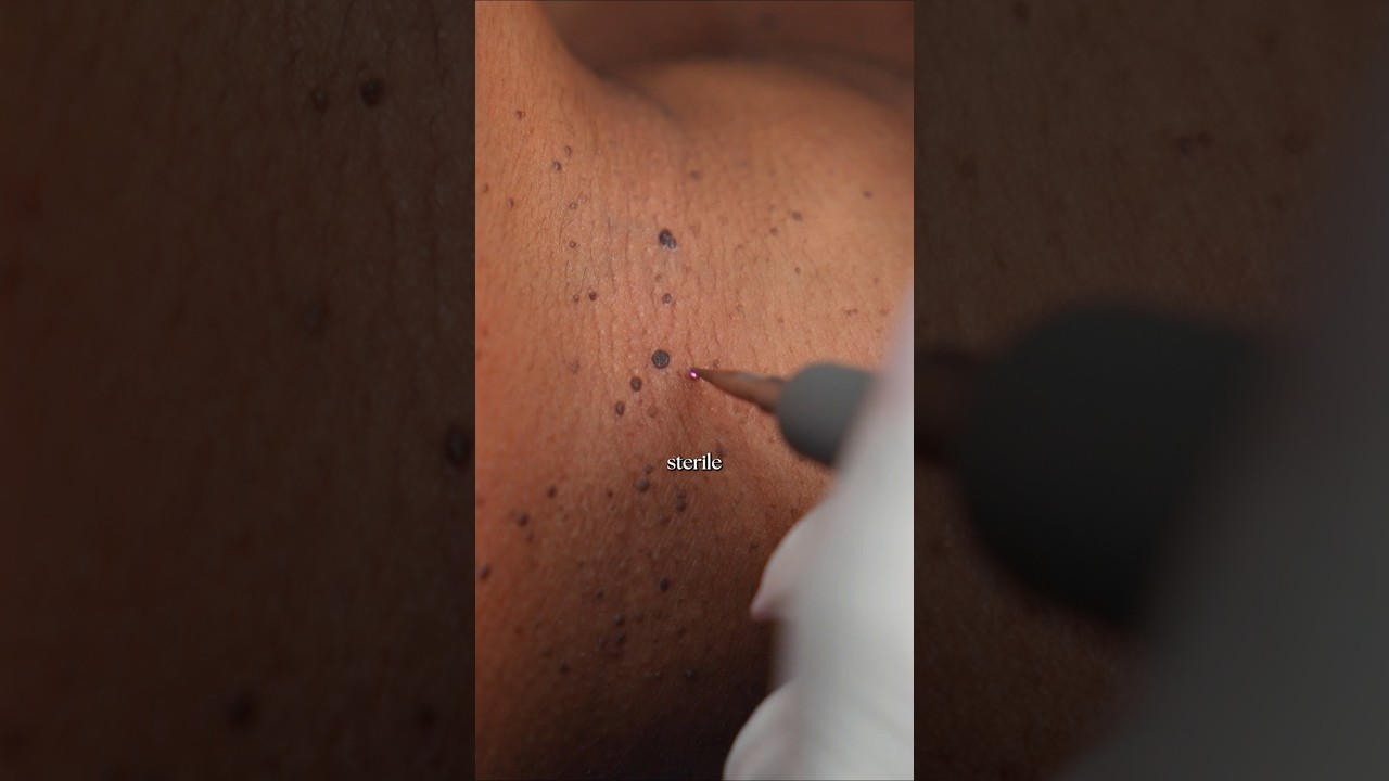 Skin tags removal at Skin Reform