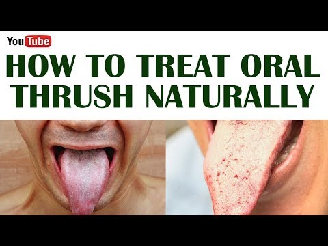 how-to-get-rid-of-thrush-quickly-|-how-to-get-rid-of-oral-thrush-naturally-natural-remedy-for-thrush