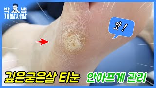 압력에 의해 생긴 깊은굳은살 티눈 제거 관리 하기   corn remove [풋스올영등포당산점]