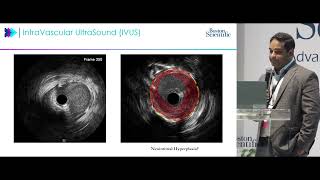 TCT 2024 Case Study | AGENT Drug-Coated Balloon Presented by Dr. Jubin Joseph, MD, PhD Wealth