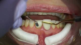 Mocking up front four veneers with composite