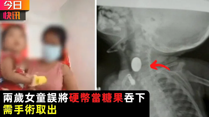 女童误将硬币当糖果吞下 需手术取出 - 天天要闻