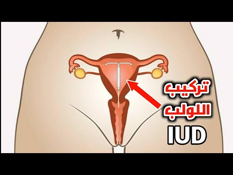 شاهد كيف يتم تركيب لولب منع الحمل داخل الرحم How To Insert An IUD To Prevent Pregnancy 