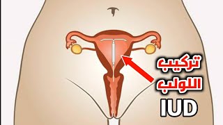 شاهد كيف يتم تركيب لولب منع الحمل داخل الرحم_How to insert an IUD to prevent pregnancy