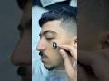 ازالة الحبايه المتسلطنة من الوجه       