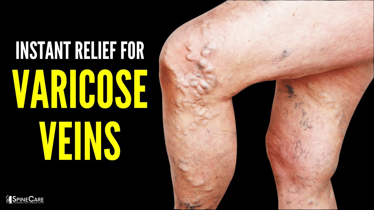 How to Instantly Relieve Varicose Vein Pain 