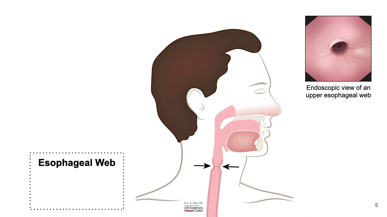 American Journal of Case Reports | Plummer-Vinson Syndrome: A Rare Cause of  Dysphagia in an Octogenarian - Article abstract #929899