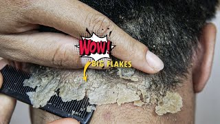 Big Dandruff Flakes Scratching
