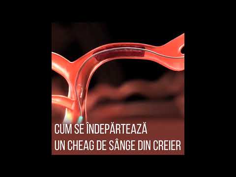 Video: Cum Se Simte Un Cheag De Sânge?