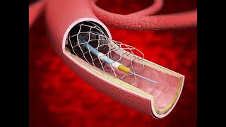 ABPP-CN: Acute Stroke Treatment