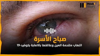 التهاب ملتحمة العين وعلاقتها بالاصابة بكوفيد-19