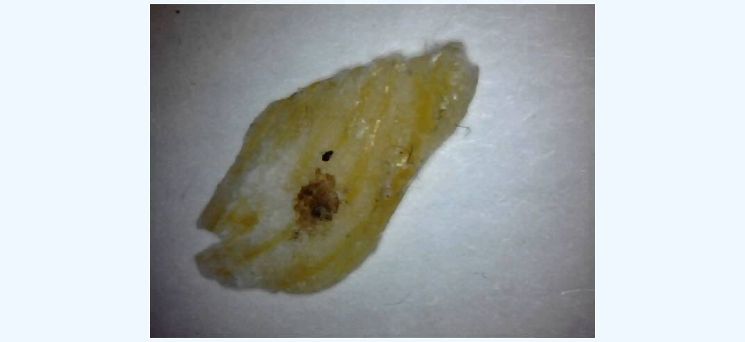 Morgellons Disease Is a Fungi (Paenibacillus odorifer) & The Cure - highly contagious