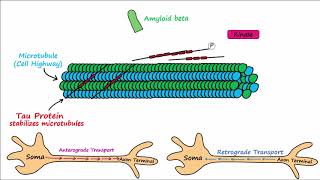 Alzheimer's Disease - plaques, tangles, pathogenesis, risk factors, disease progression