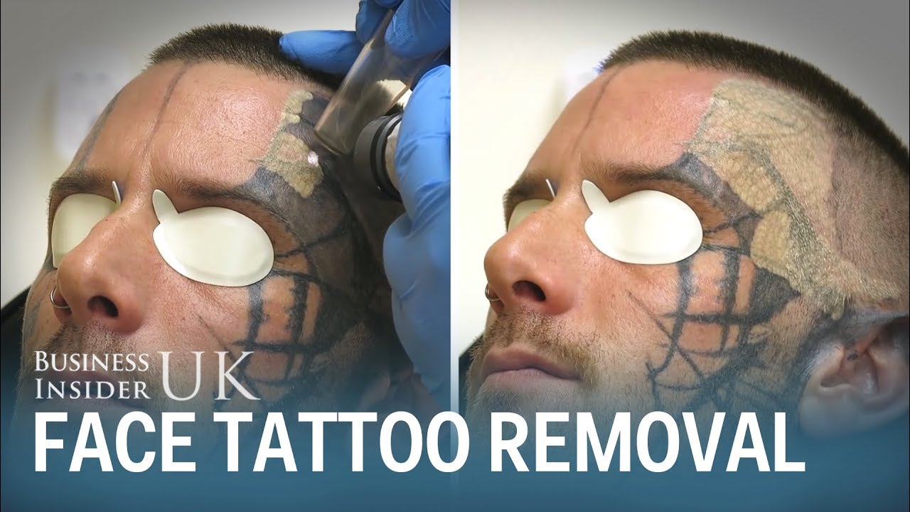Watch This Man Have His Face Tattoo Removed From Laser Surgery | Business Insider