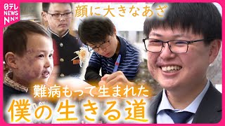 【難病】第一志望に合格顔のあざと生きる岩川雅治さん 苦悩の日々と新たな夢への挑戦　山形　NNNセレクション