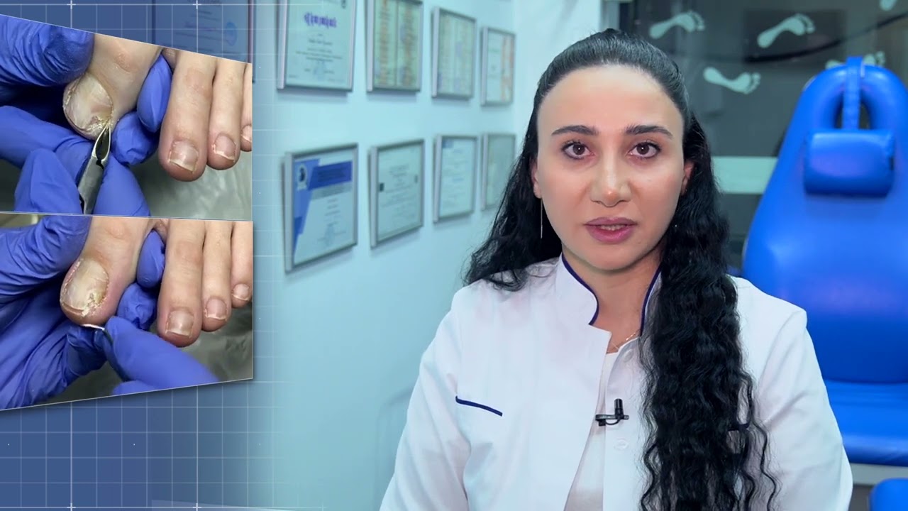 Սնկային ախտահարման բուժում (օնիխոմիկոզ)