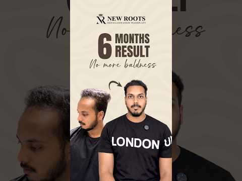 Hair Transplant in Nashik (6 Months Result) | Cost of Hair Transplant #hair #shorts