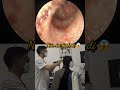 Extreme Earwax Suction Procedure 🔥 | Deep Impacted Wax Removal #ENTSpecialist #Viral #Medical