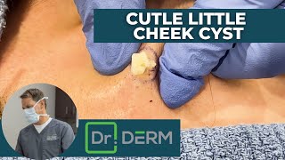 Cute Little Cheek Cyst | Dr. Derm