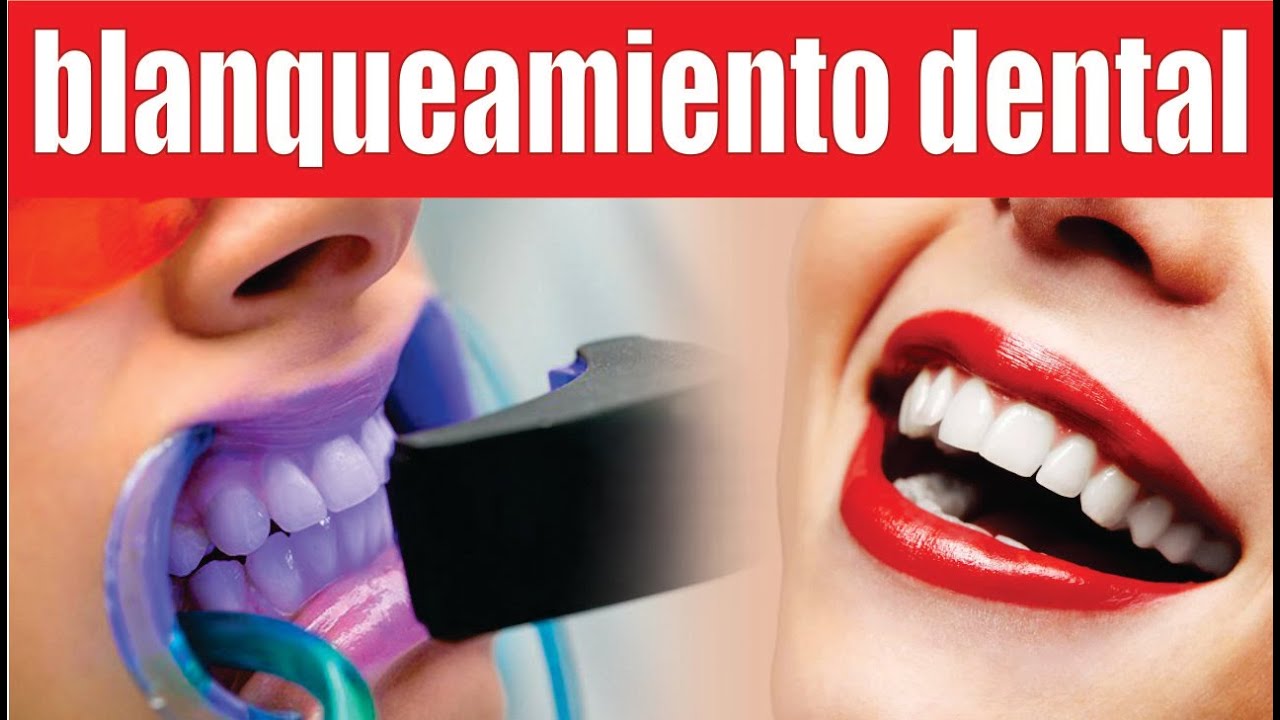 TIPOS DE BLANQUEMIANTO DENTAL 🦷 (láser, led y convencional) 🦷 MITOS y VERDADES 📌 Dr SANTIAGO BURGA