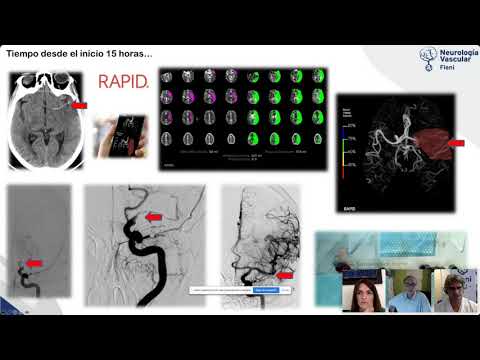 Webinar Fleni Rehabilitación: Rehabilitación multidisciplinaria para pacientes adultos con ACV