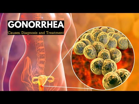 Gonorrhea, Causes, Signs and Symptoms, Diagnosis and Treatment.