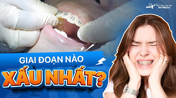Giai Đoạn Xấu Nhất Khi Niềng Răng: Giai Đoạn Xấu Nhất Khi Niềng Răng Là Khi Nào? (Bật Mí Phút Thứ 2)